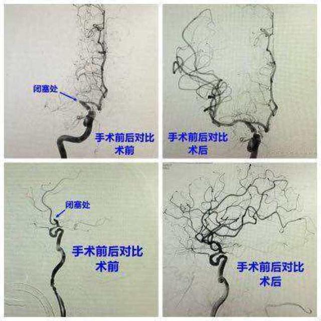 83岁老人急性颅内大动脉闭塞，在无棣县人民医院成功救治